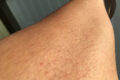 Weniger Haare, mehr Hautirritationen